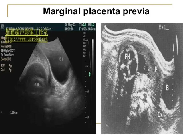 Мarginal placenta previa