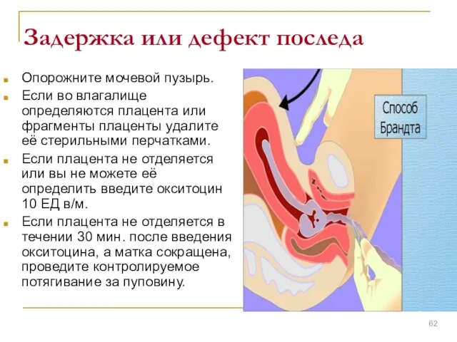 Задержка или дефект последа Опорожните мочевой пузырь. Если во влагалище