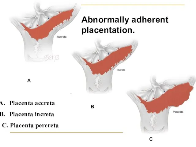 Placenta accreta Placenta increta C. Placenta percreta A B C Abnormally adherent placentation.