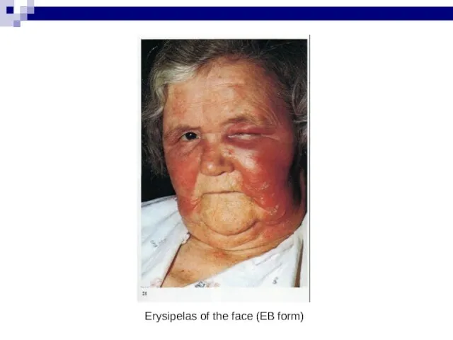Erysipelas of the face (EB form)