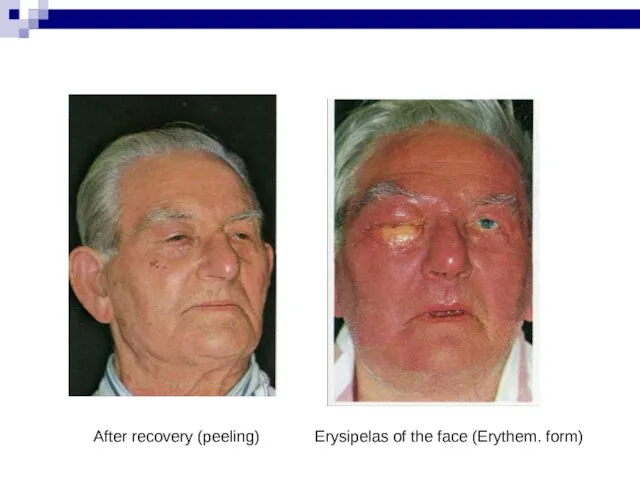 Erysipelas of the face (Erythem. form) After recovery (peeling)