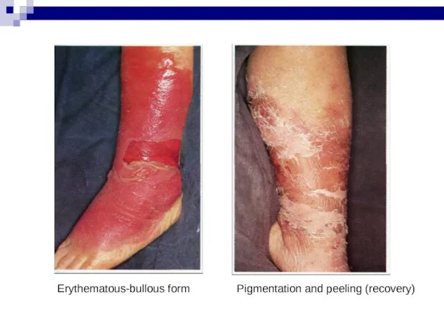 Erythematous-bullous form Pigmentation and peeling (recovery)