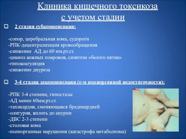 Клиника кишечного токсикоза с учетом стадии 2 стадия субкомпенсации: -сопор,