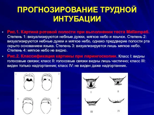 ПРОГНОЗИРОВАНИЕ ТРУДНОЙ ИНТУБАЦИИ Рис.1. Картина ротовой полости при выполнении теста