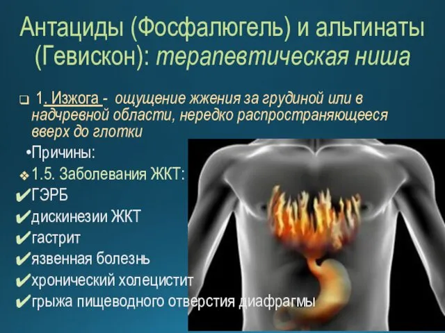 Антациды (Фосфалюгель) и альгинаты (Гевискон): терапевтическая ниша 1. Изжога -