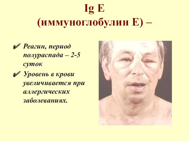 Ig Е (иммуноглобулин Е) – Реагин, период полураспада – 2-5 суток Уровень в
