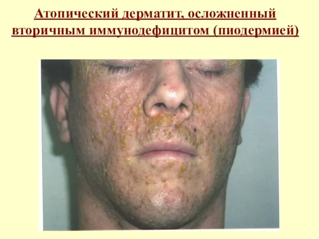 Атопический дерматит, осложненный вторичным иммунодефицитом (пиодермией)