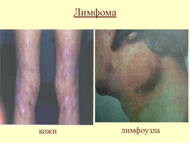Лимфома кожи лимфоузла