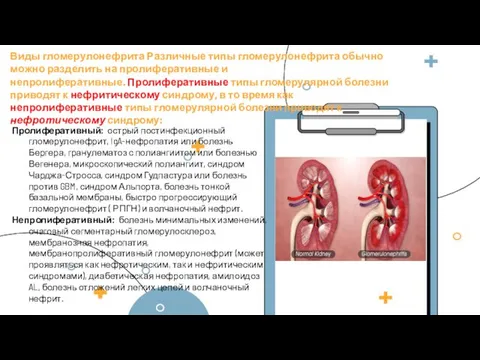 Пролиферативный: острый постинфекционный гломерулонефрит, IgA-нефропатия или болезнь Бергера, гранулематоз с