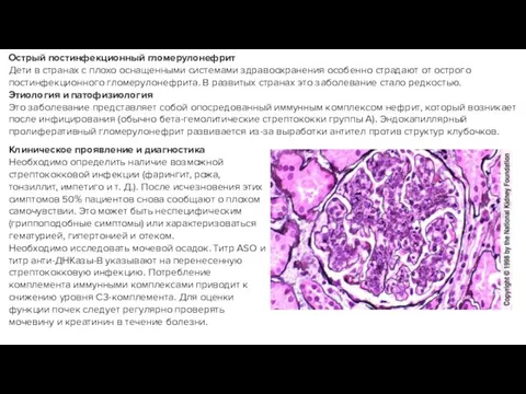 Острый постинфекционный гломерулонефрит Дети в странах с плохо оснащенными системами