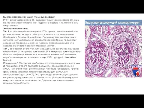 Быстро прогрессирующий гломерулонефрит РПГН встречается редко. Он вызывает заметное снижение