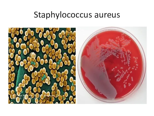 Staphylococcus aureus