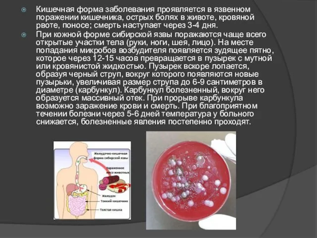 Кишечная форма заболевания проявляется в язвенном поражении кишечника, острых болях