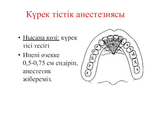 Күрек тістік анестезиясы Нысана көзі: күрек тісі тесігі Инені өзекке 0,5-0,75 см ендіріп, анестетик жібереміз.