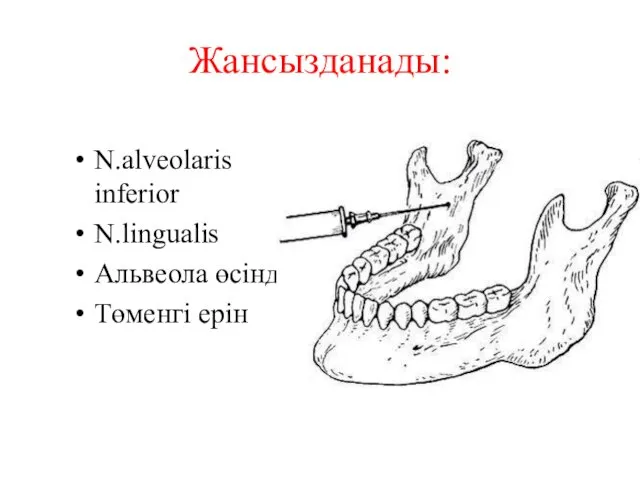 Жансызданады: N.alveolaris inferior N.lingualis Альвеола өсіндісі Төменгі ерін