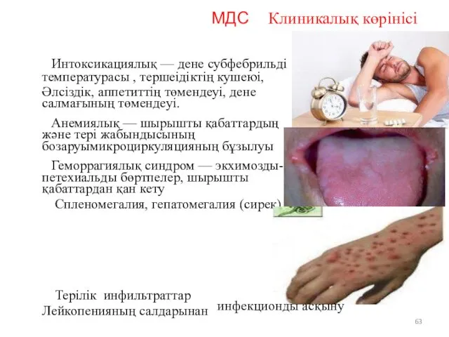 МДС Клиникалық көрінісі Интоксикациялық — дене субфебрильді температурасы , тершеідіктің кушеюі, Әлсіздік, аппетиттің