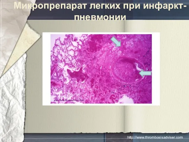 Микропрепарат легких при инфаркт-пневмонии http://www.thrombosisadviser.com