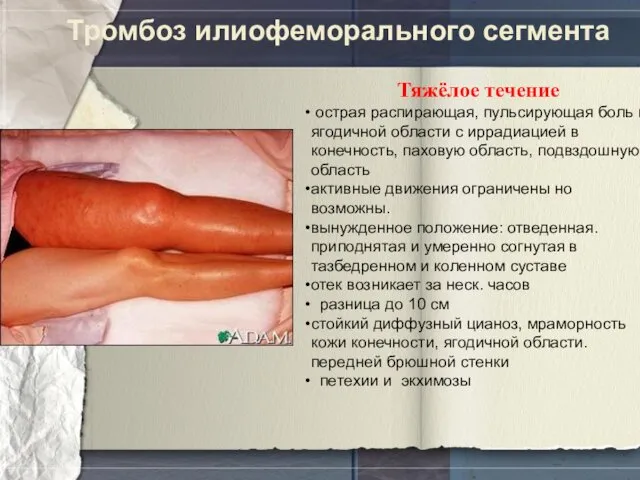 Тромбоз илиофеморального сегмента Тяжёлое течение острая распирающая, пульсирующая боль в ягодичной области с