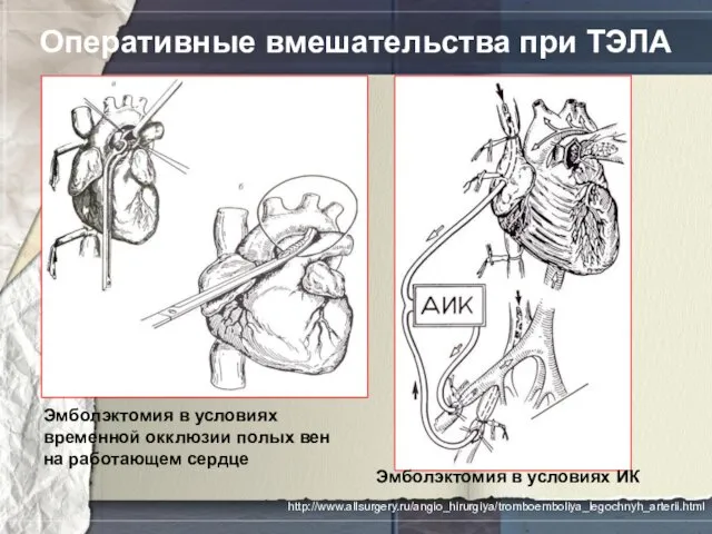 Оперативные вмешательства при ТЭЛА Эмболэктомия в условиях временной окклюзии полых