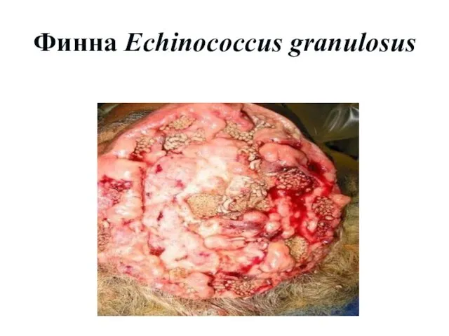 Финна Echinococcus granulosus