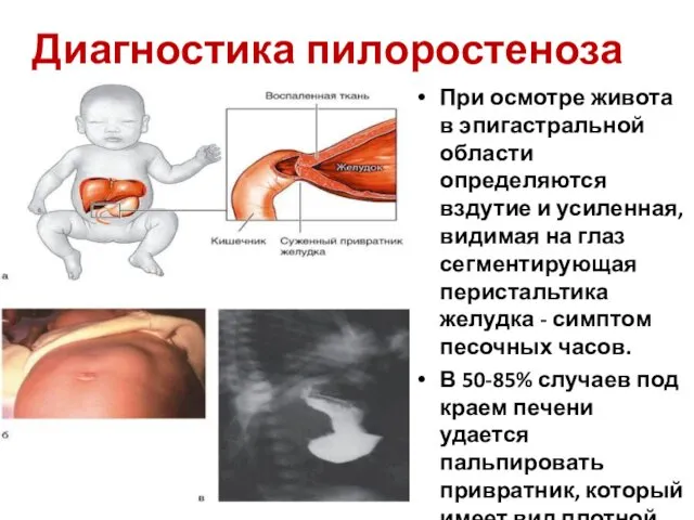 Диагностика пилоростеноза При осмотре живота в эпигастральной области определяются вздутие и усиленная, видимая