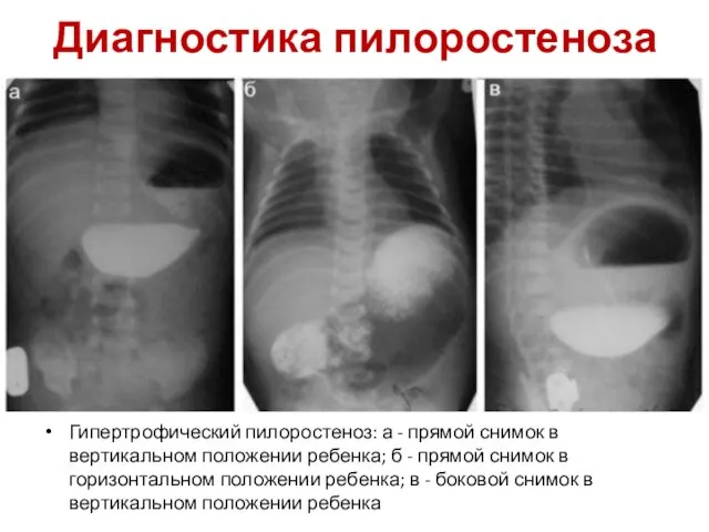 Диагностика пилоростеноза Гипертрофический пилоростеноз: а - прямой снимок в вертикальном положении ребенка; б