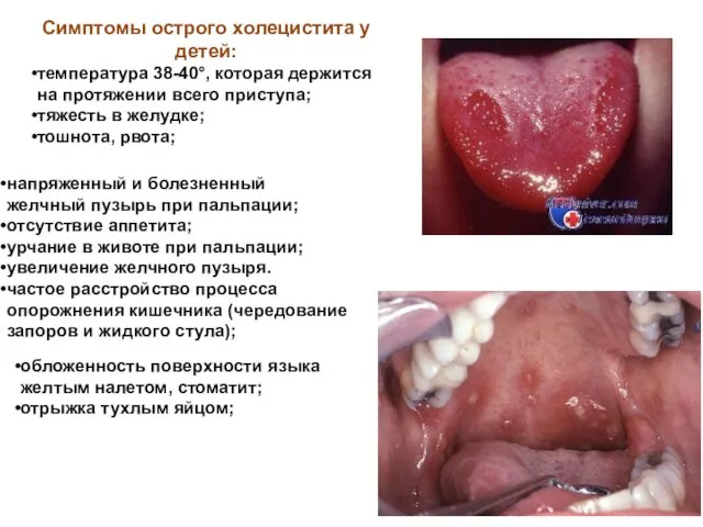 Симптомы острого холецистита у детей: температура 38-40°, которая держится на протяжении всего приступа;