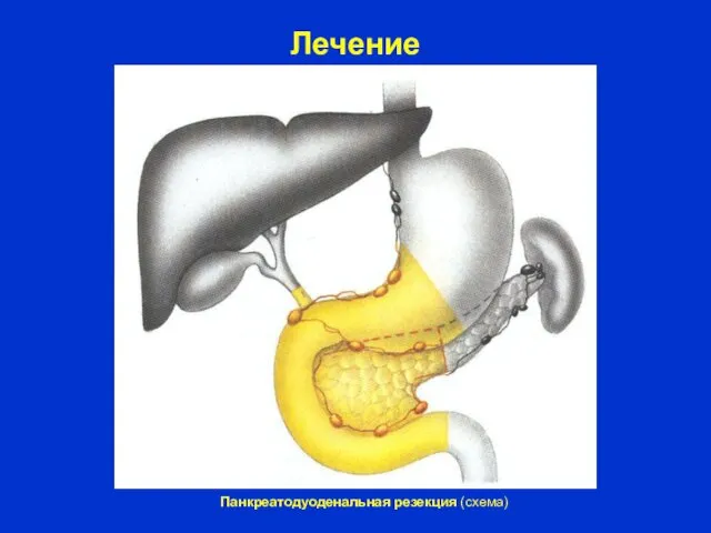 Лечение Панкреатодуоденальная резекция (схема)