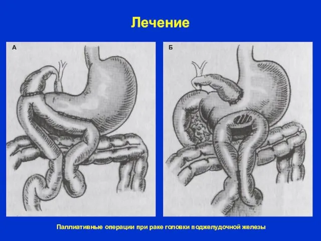 Лечение А Б Паллиативные операции при раке головки поджелудочной железы