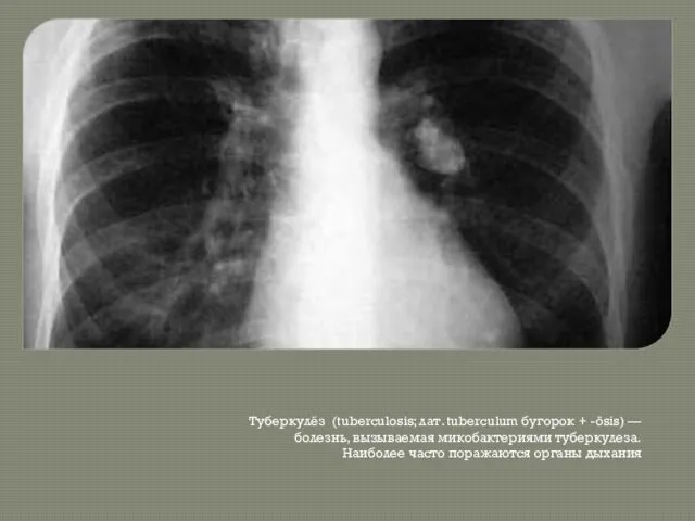 Туберкулёз (tuberculosis; лат. tuberculum бугорок + -ōsis) — болезнь, вызываемая