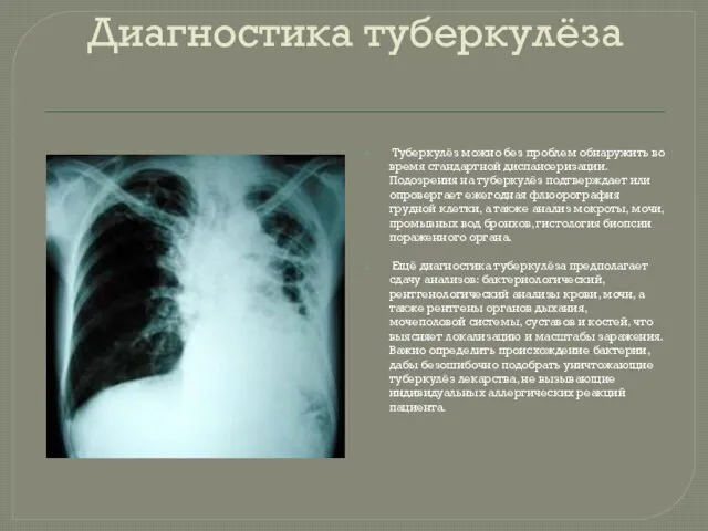 Диагностика туберкулёза Туберкулёз можно без проблем обнаружить во время стандартной
