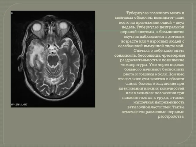 Туберкулез головного мозга и мозговых оболочек: возникает чаще всего на