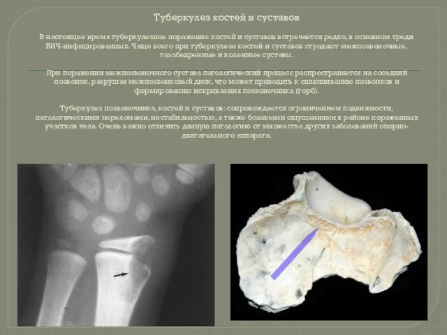 Туберкулез костей и суставов В настоящее время туберкулезное поражение костей