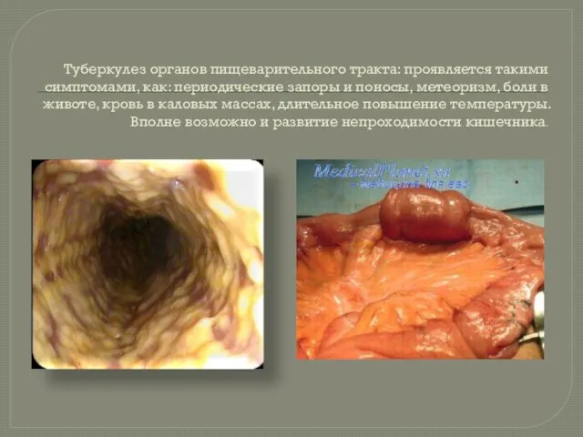 Туберкулез органов пищеварительного тракта: проявляется такими симптомами, как: периодические запоры