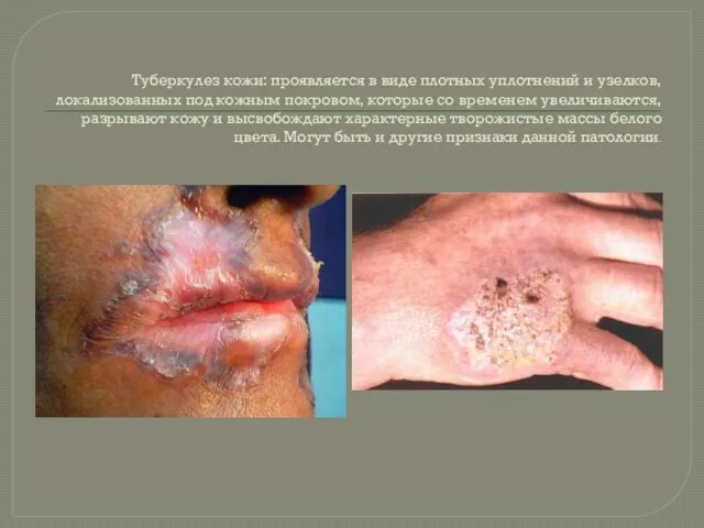 Туберкулез кожи: проявляется в виде плотных уплотнений и узелков, локализованных
