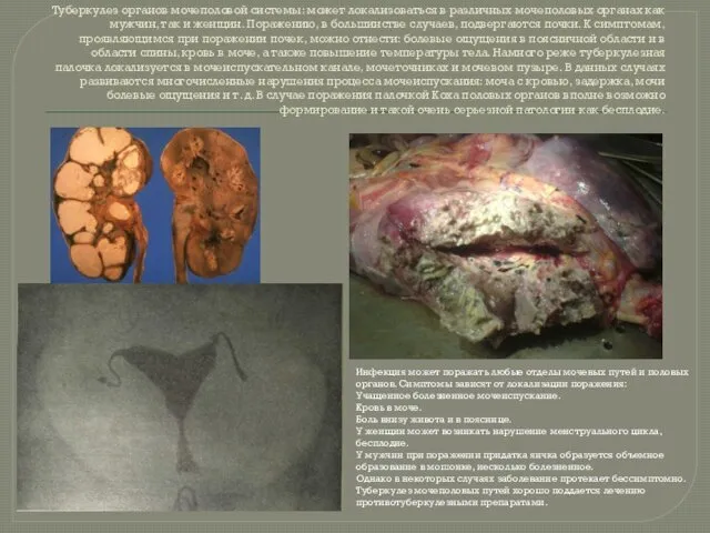 Туберкулез органов мочеполовой системы: может локализоваться в различных мочеполовых органах