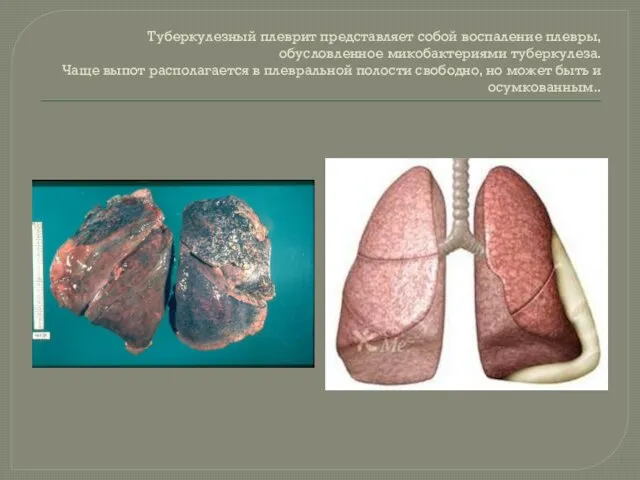 Туберкулезный плеврит представляет собой воспаление плевры, обусловленное микобактериями туберкулеза. Чаще