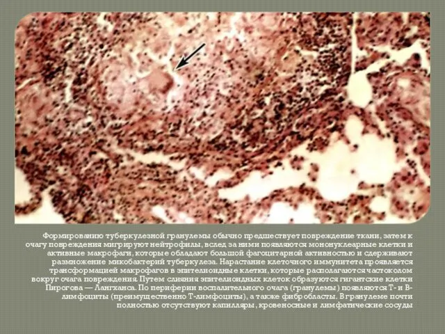 Формированию туберкулезной гранулемы обычно предшествует повреждение ткани, затем к очагу