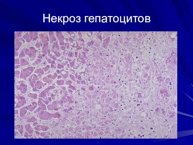 Некроз гепатоцитов