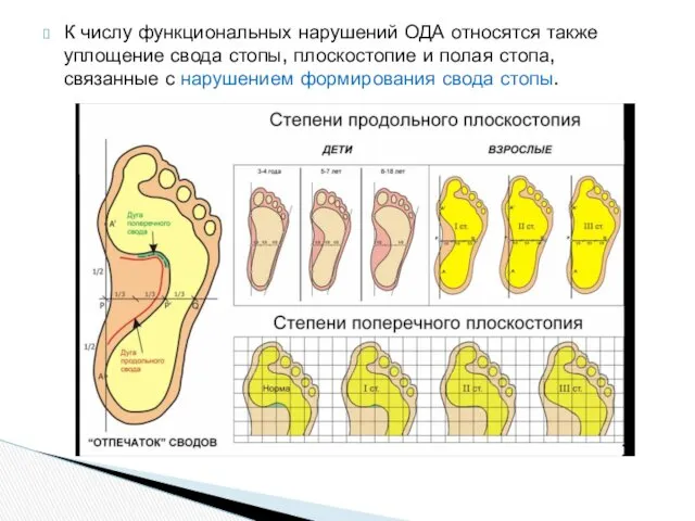 К числу функциональных нарушений ОДА относятся также уплощение свода стопы,