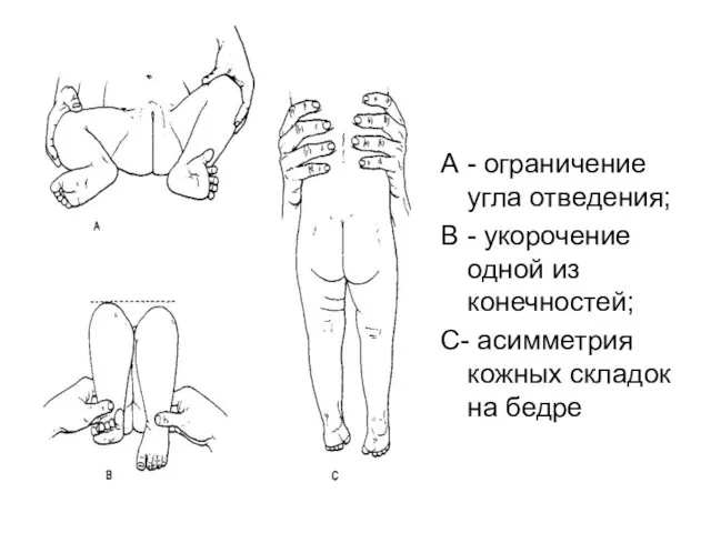 А - ограничение угла отведения; В - укорочение одной из