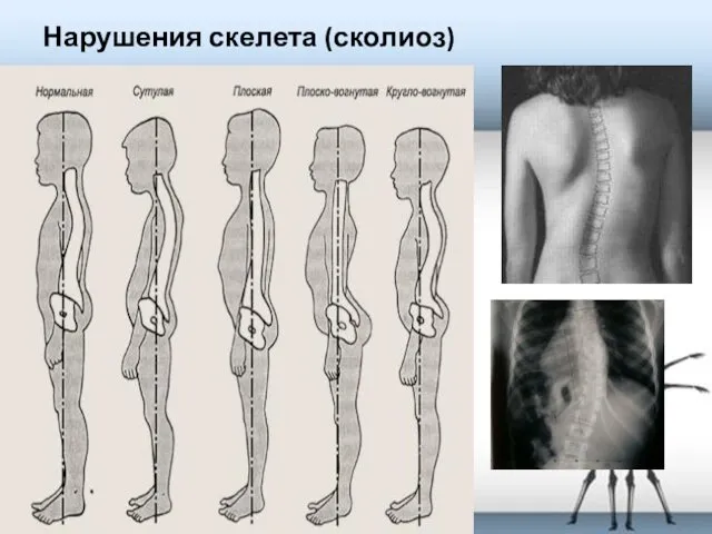 Нарушения скелета (сколиоз)