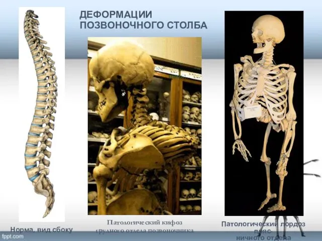 ДЕФОРМАЦИИ ПОЗВОНОЧНОГО СТОЛБА Патологический лордоз пояс- ничного отдела позвоночника Патологический