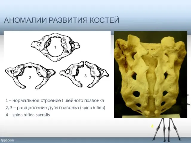 АНОМАЛИИ РАЗВИТИЯ КОСТЕЙ 1 – нормальное строение I шейного позвонка