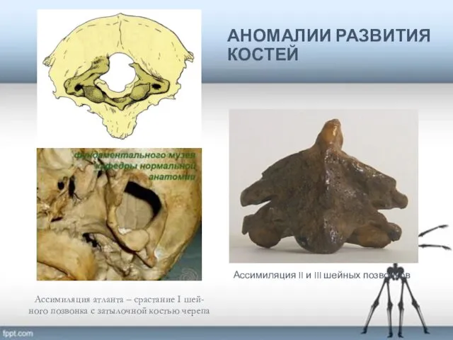 АНОМАЛИИ РАЗВИТИЯ КОСТЕЙ Ассимиляция II и III шейных позвонков Ассимиляция