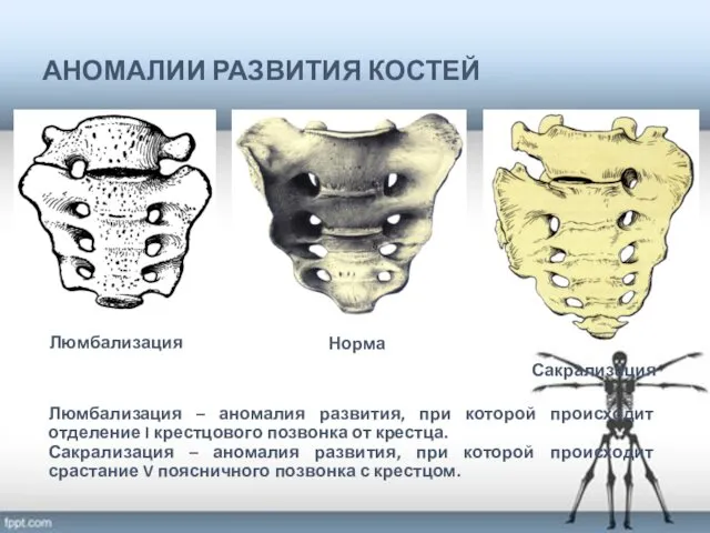 АНОМАЛИИ РАЗВИТИЯ КОСТЕЙ Люмбализация – аномалия развития, при которой происходит