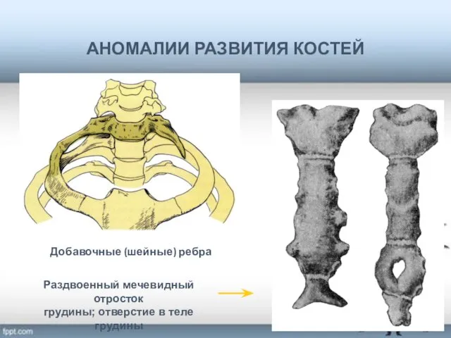 АНОМАЛИИ РАЗВИТИЯ КОСТЕЙ Добавочные (шейные) ребра Раздвоенный мечевидный отросток грудины; отверстие в теле грудины