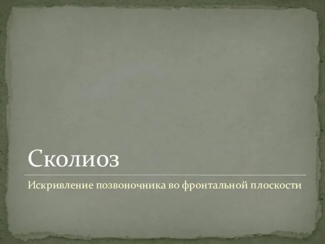 Сколиоз Искривление позвоночника во фронтальной плоскости