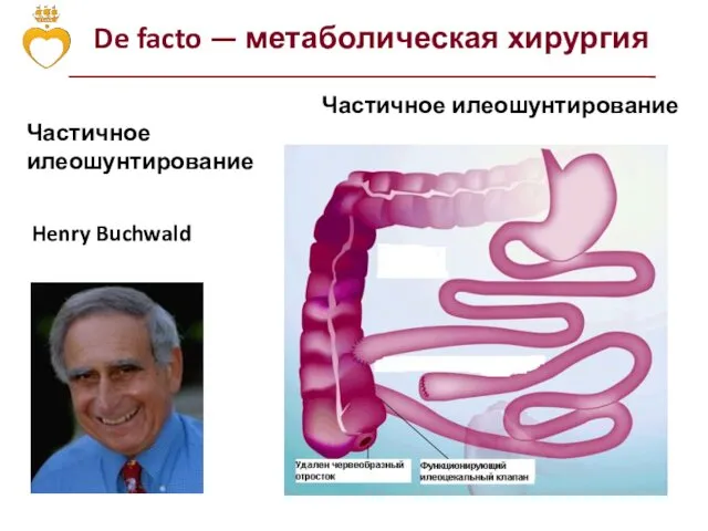 De facto — метаболическая хирургия Henry Buchwald Частичное илеошунтирование Частичное илеошунтирование