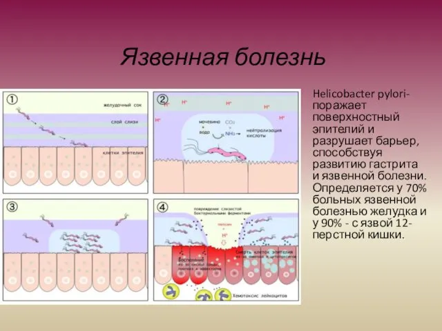 Язвенная болезнь Helicobacter pylori- поражает поверхностный эпителий и разрушает барьер,